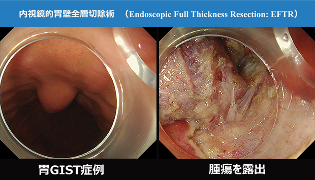 胃GIST症例、腫瘍を露出